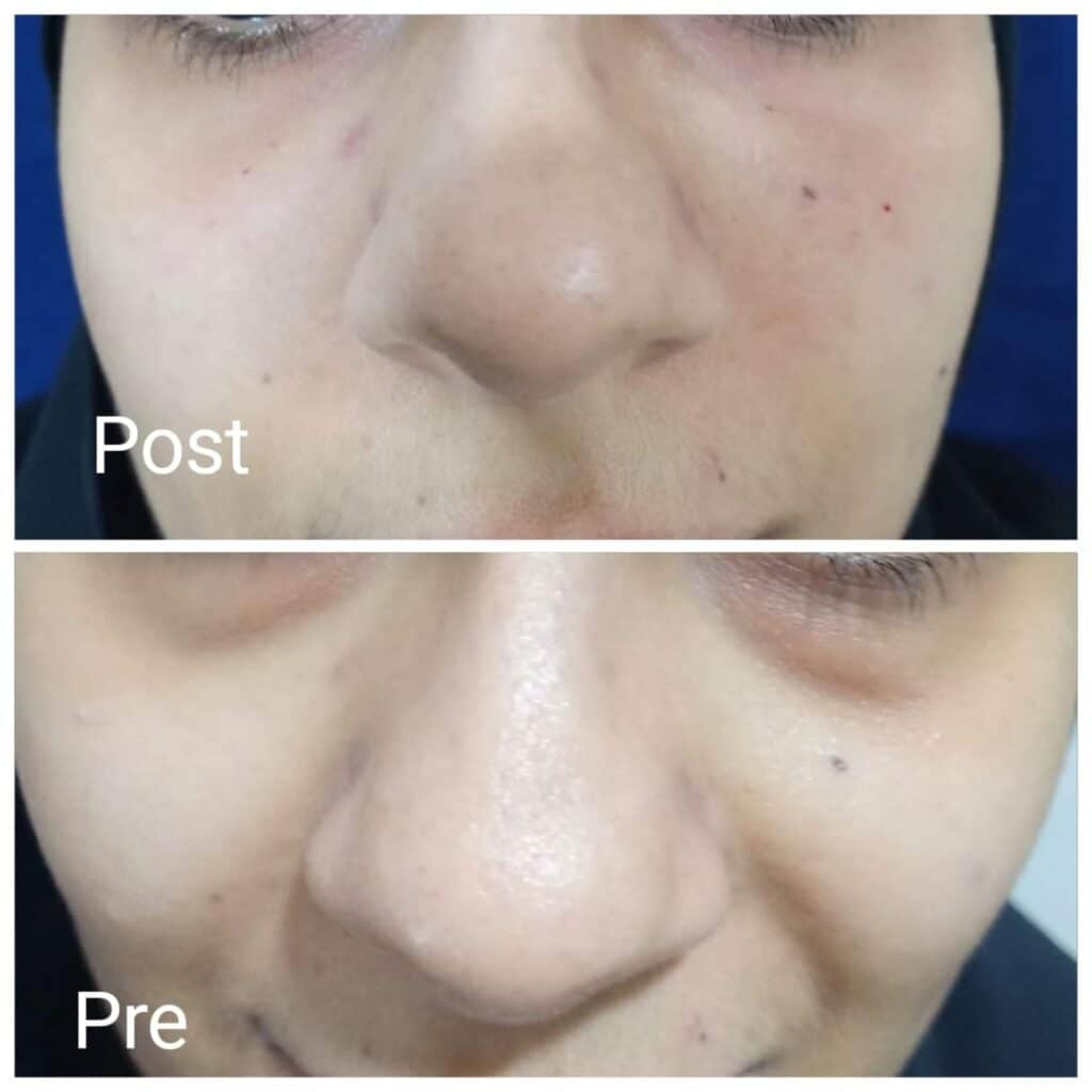 Dark circles therapy sessions in Hurghada